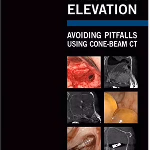 Sinus Floor Elevation: Avoiding Pitfalls Using Cone-Beam Ct