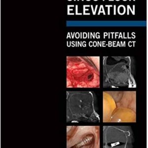 Sinus Floor Elevation: Avoiding Pitfalls Using Cone-Beam Ct