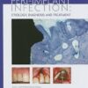 Peri-Implant Infection: Etiology, Diagnosis And Therapy