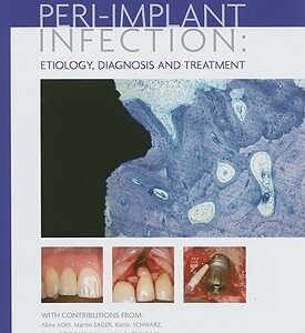 Peri-Implant Infection: Etiology, Diagnosis And Therapy