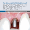 Contemporary Restoration Of Endodontically Treated Teeth