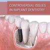 Controversial Issues In Implant Dentistry