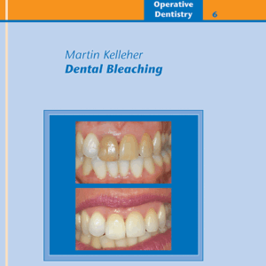 Dental Bleaching