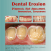 Dental Erosion