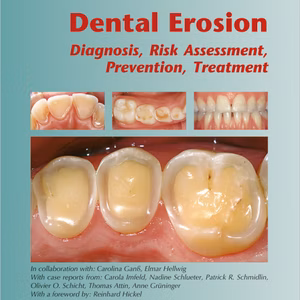 Dental Erosion