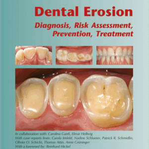 Dental Erosion
