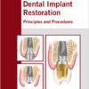 Dental Implant Restoration