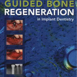 Guided Bone Regeneration Second Edition
