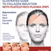 Illustrated Guide To Collagen Induction With Platelet-Rich Plasma (Prp)