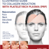 Illustrated Guide To Collagen Induction With Platelet-Rich Plasma (Prp)