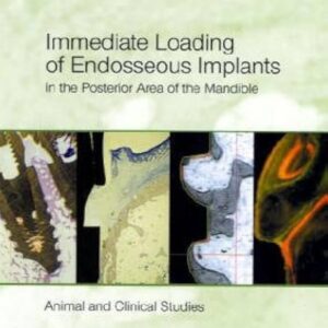 Immediate Loading Of Endosseous Implants