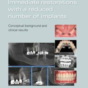 Immediate Restorations With A Reduced Number Of Implants