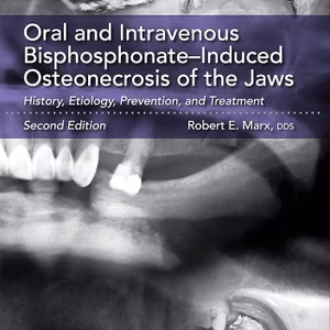 Oral And Intravenous Bisphosphonate-Induced Osteonecrosis Of The Jaws Second Edition