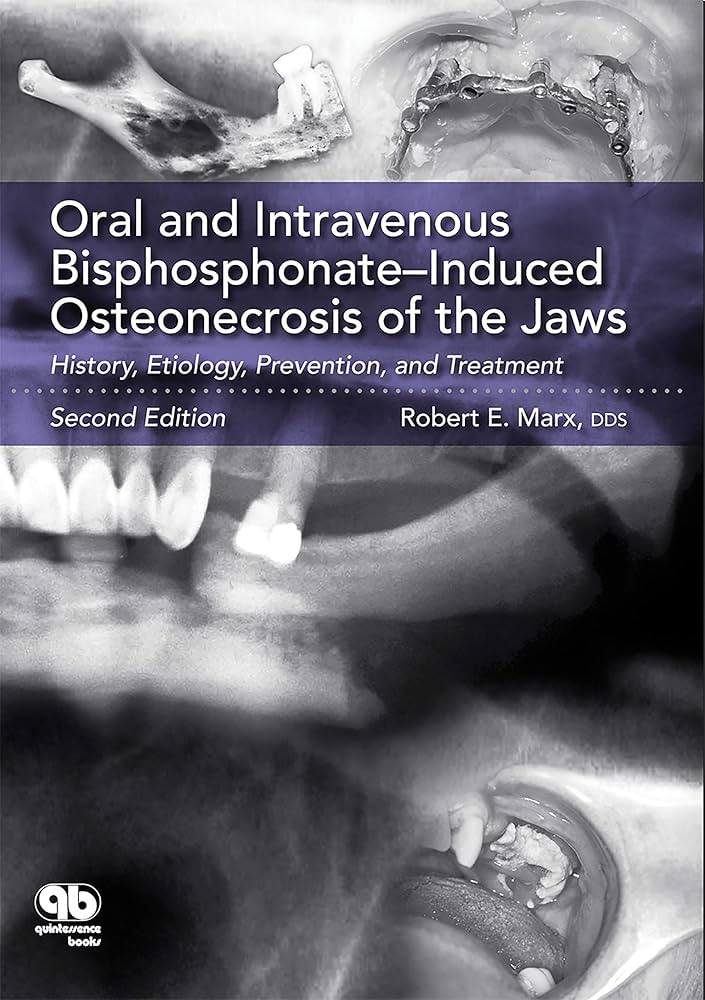 Oral And Intravenous Bisphosphonate-Induced Osteonecrosis Of The Jaws Second Edition