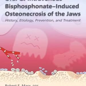 Oral & Intravenous Bisphosphonate-Induced Osteonecrosis Of The Jaws