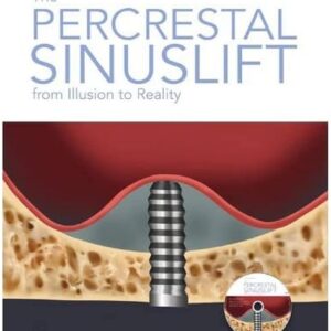 Percrestal Sinuslift- From Illusion To Reality