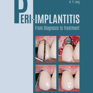 Peri-Implantitis