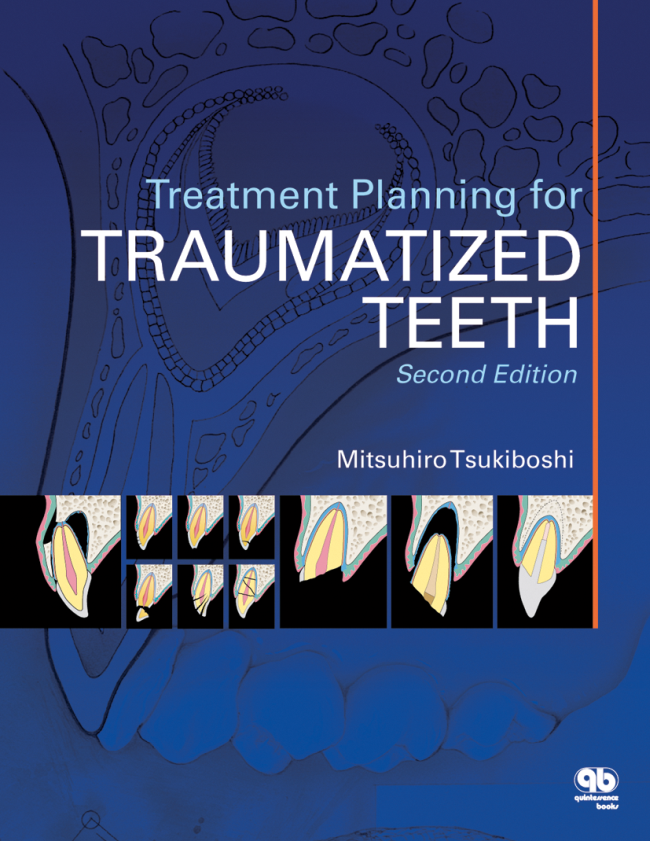 Treatment Planning For Traumatized Teeth Second Edition