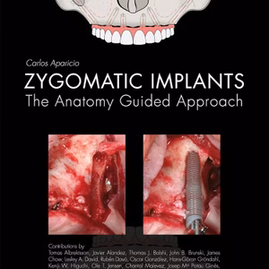 Zygomatic Implants- The Anatomy Guided Approach