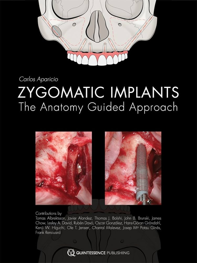 Zygomatic Implants- The Anatomy Guided Approach