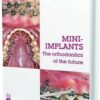 Mini-Implants: The Orthodontics Of The Future