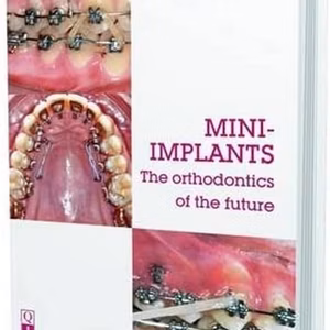 Mini-Implants: The Orthodontics Of The Future