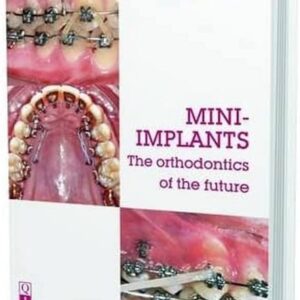 Mini-Implants: The Orthodontics Of The Future