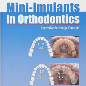 Mini-Implants In Orthodontics: Innovative Anchorage Concepts