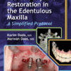 Esthetic Implant Restoration In The Edentulous Maxilla: A Simplified Protocol