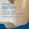 Rbfdps Resin-Bonded Fixed Dental Prostheses