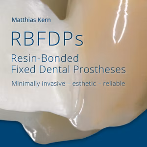 Rbfdps Resin-Bonded Fixed Dental Prostheses