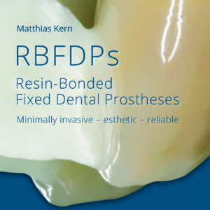 Rbfdps Resin-Bonded Fixed Dental Prostheses
