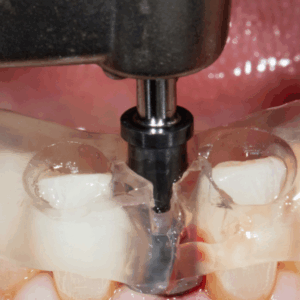 Course: Digitally Guided Implant Surgery and Restoration for Single Tooth Replacement