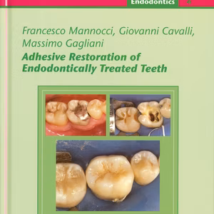 Adhesive Restoration Of Endodontically Treated Teeth